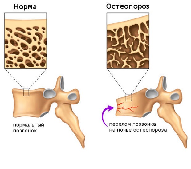 перелом позвонка при остеопорозе