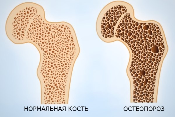 Здоровая и пораженная остеопорозом кость