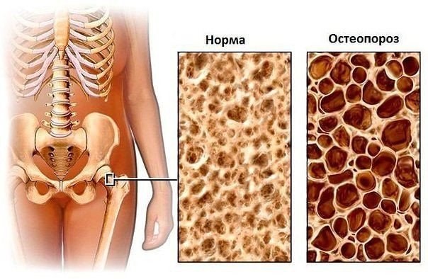 разрушение костей при остеопорозе