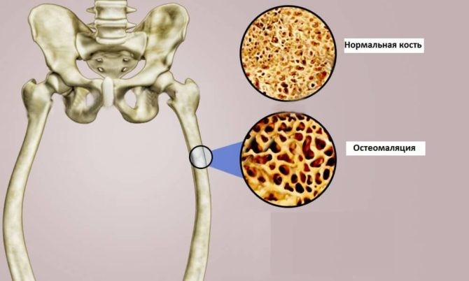разрушение костей при остеомаляции