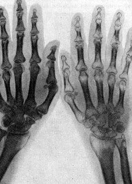 рентгенография травмированной кости