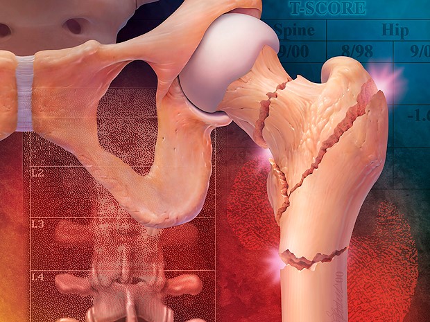 кости суставов при эпифизарном остеопорозе