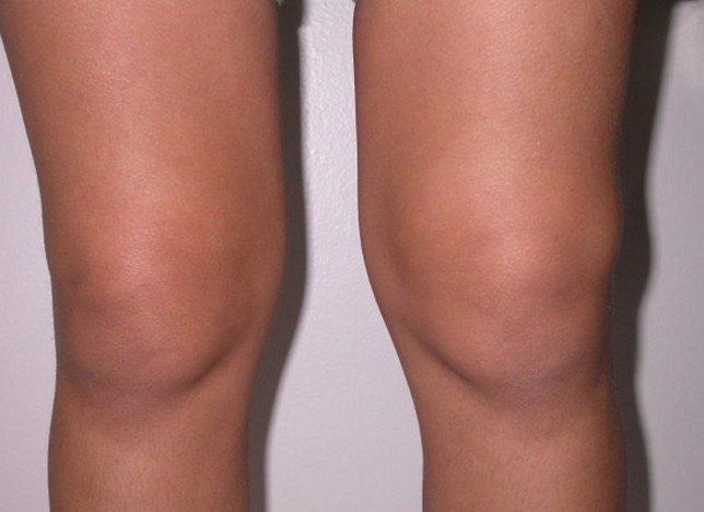 Опухоль колена
