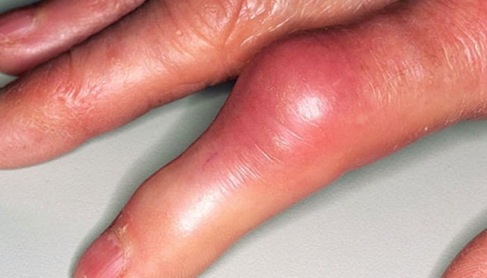 Подагрический артрит пальцев рук