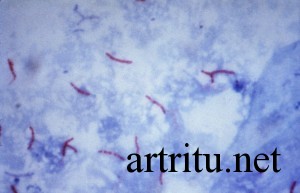 Инфекционный артрит этиология патогенез thumbnail