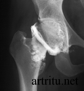 Изображение - Артрит суставов диагностика arthritis-arthrography-279x300