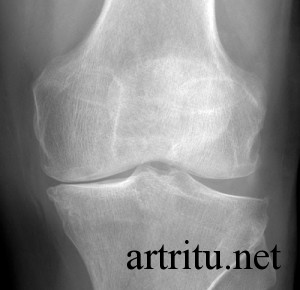 Диагностика коленного артрита