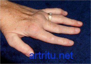 Что такое синовиты при артрите