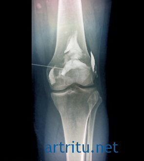 Артрита коленного сустава диагностика thumbnail