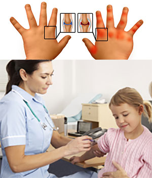 Реактивный артрит у детей лечение народными средствами thumbnail