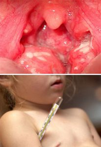 Проявление ревматоидного артрита у детей thumbnail