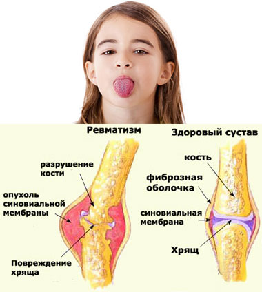 Ревматизм у детей картинки