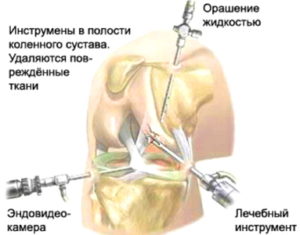 Артроскопия коленного сустава фото