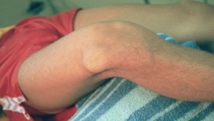 Хондроматоз коленного сустава лечение народными средствами thumbnail