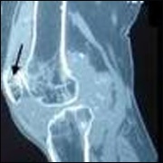 Хондроматоз коленного сустава народные средства лечения thumbnail