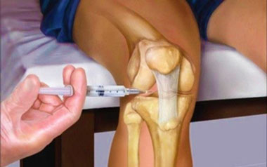 Артрит коленного сустава курс лечения thumbnail