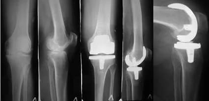 Рентген-снимок коленного сустава