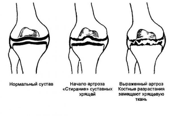 Фото артроз суставов рук