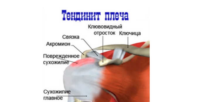 Резкая боль в левом плечевом суставе лечение thumbnail