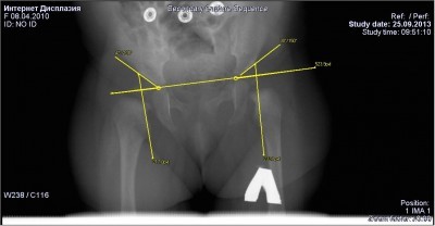 Дисплазия суставов лечение фото thumbnail