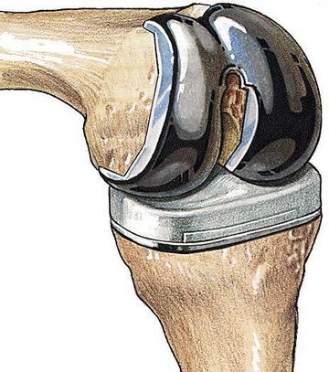 Артропластика коленного сустава