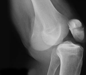 Рентгеновский снимок колена с артритом thumbnail