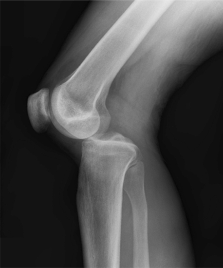 Снимок колена с артритом thumbnail