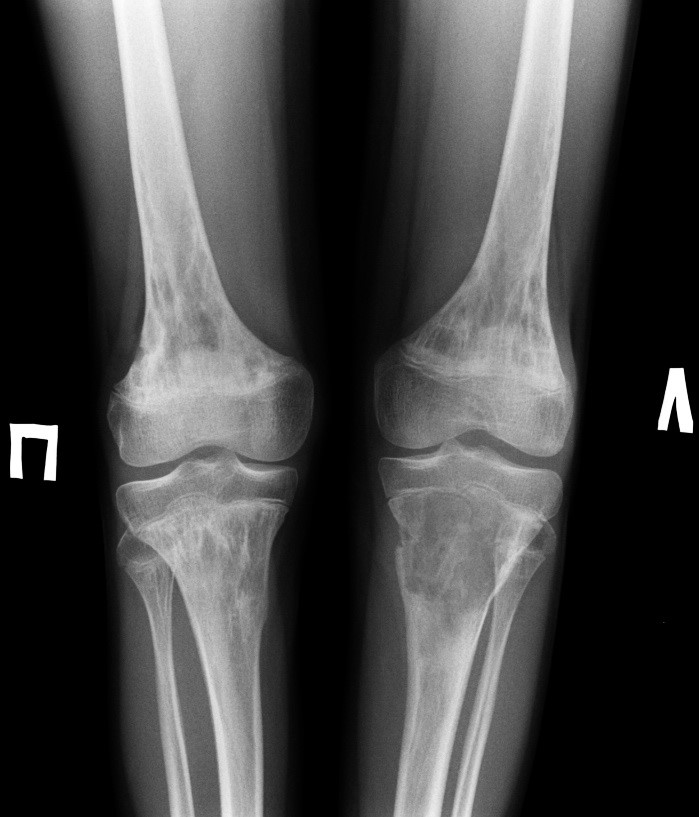 Рентгеновский снимок коленных суставов при артрозе фото thumbnail