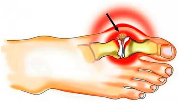 Почему болит сустав большого пальца на ноге лечение thumbnail