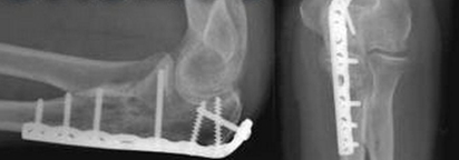 Изображение - Признаки перелома в локтевом суставе perelom-ruki-operativnoe-lechenie