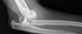 Рентген перелома руки в локтевом суставе