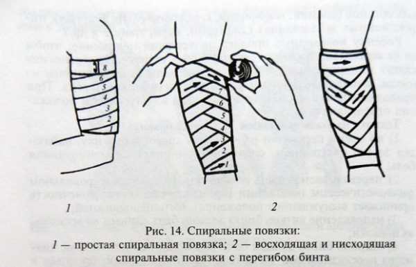 Пиявки на колено схема постановки