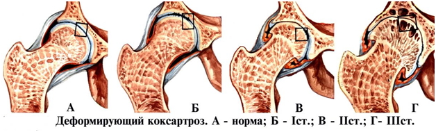 Диспластический остеоартроз тазобедренных суставов thumbnail