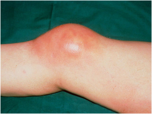 Бурсит может быть причиной отека сустава ноги