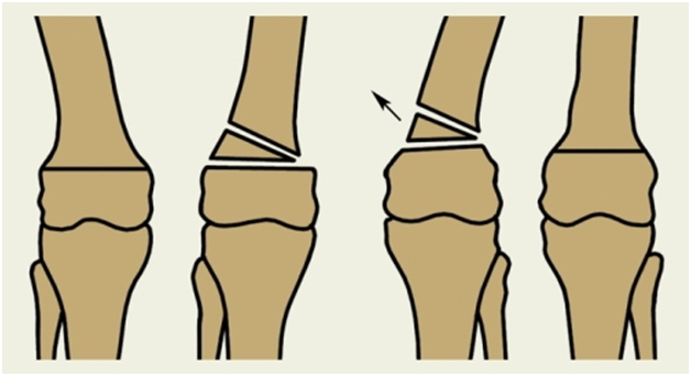 Деформирующий артроз коленного сустава корригирующая остеотомия thumbnail