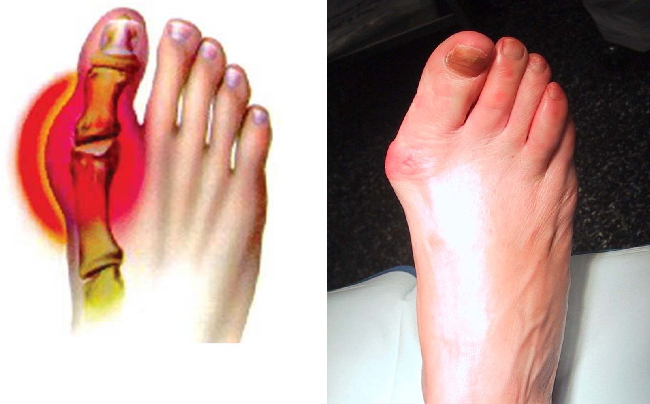 Лечение остеоартроза сустава стопы ноги thumbnail