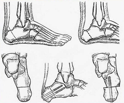 Деформирующий артроз коленного сустава корригирующая остеотомия
