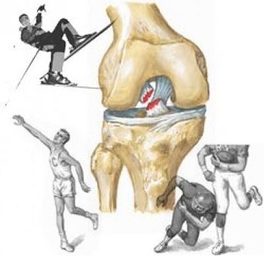 Изображение - Заболевания коленного сустава травматология povrezhdenie-svyazok-e1505926474219