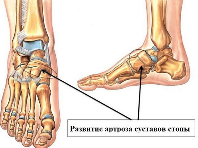 Остеоартроз стоп ног лечение thumbnail