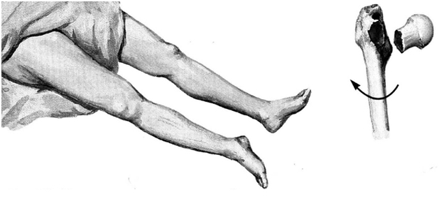 Изображение - Предвывих тазобедренного сустава у взрослых simptomy-smesheniya-tazobedrennogo-sustava