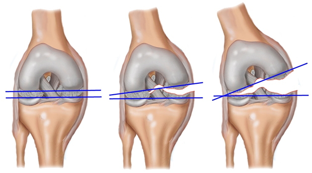 Изображение - Заболевания коленного сустава травматология travmy-kolena