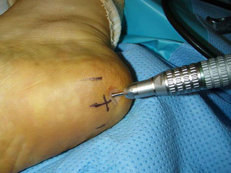 Лечение лазером шпор на ногах thumbnail
