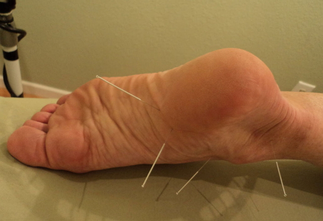 Санатории для лечения шпор на ногах thumbnail