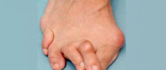 Искривление пальцев стопы