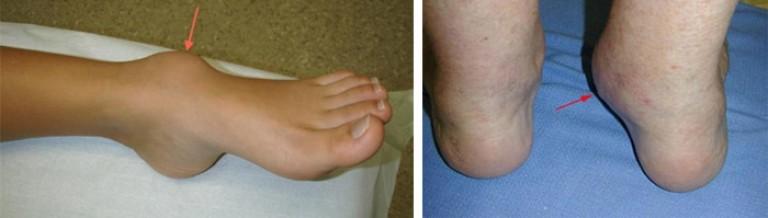 Лечение остеоартроза коленного и голеностопного сустава thumbnail
