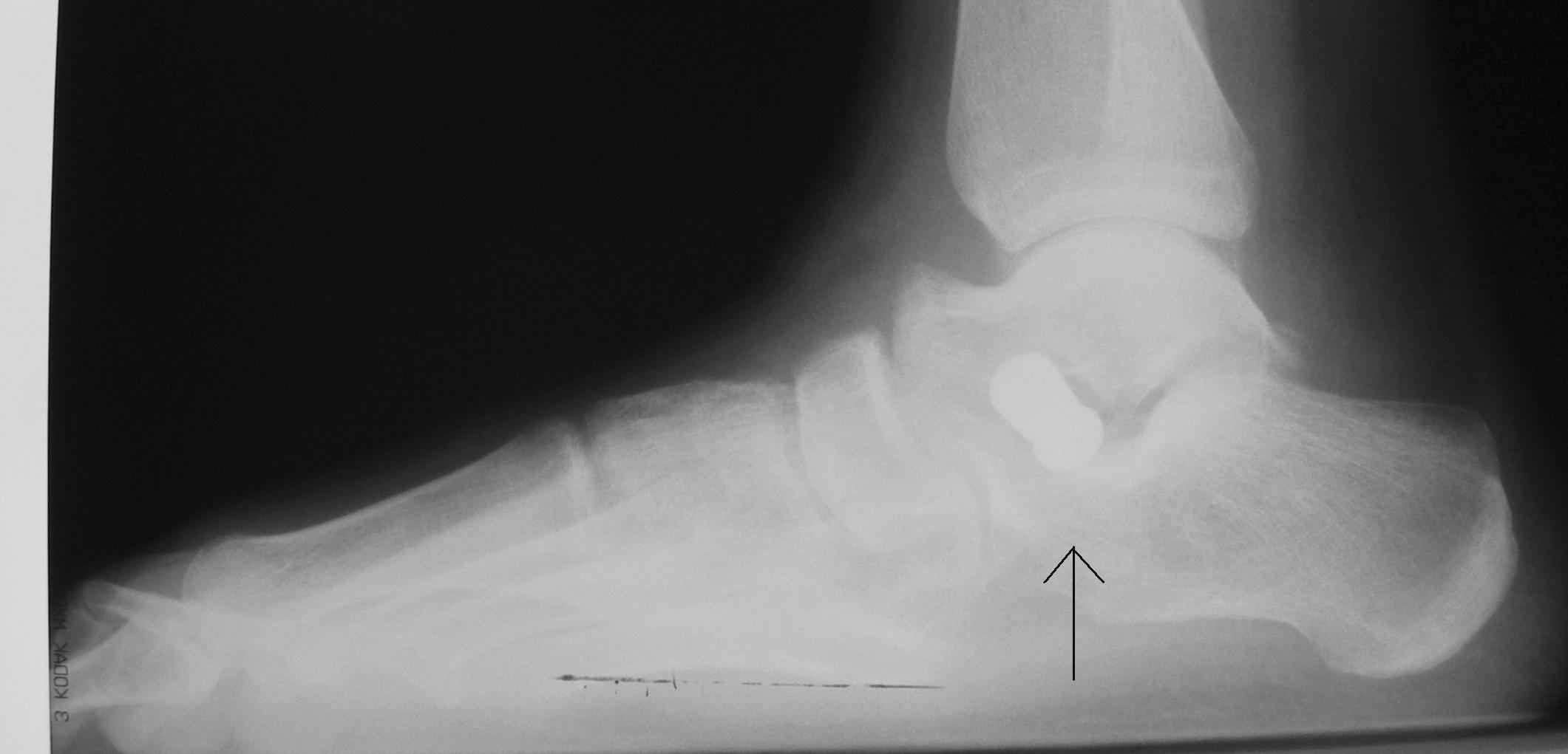 Изображение - Артроэрез подтаранного сустава у взрослых rentgen-posle-operacii
