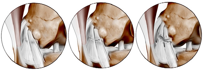 Как восстановить колено и связки после травмы реабилитация после разрыва