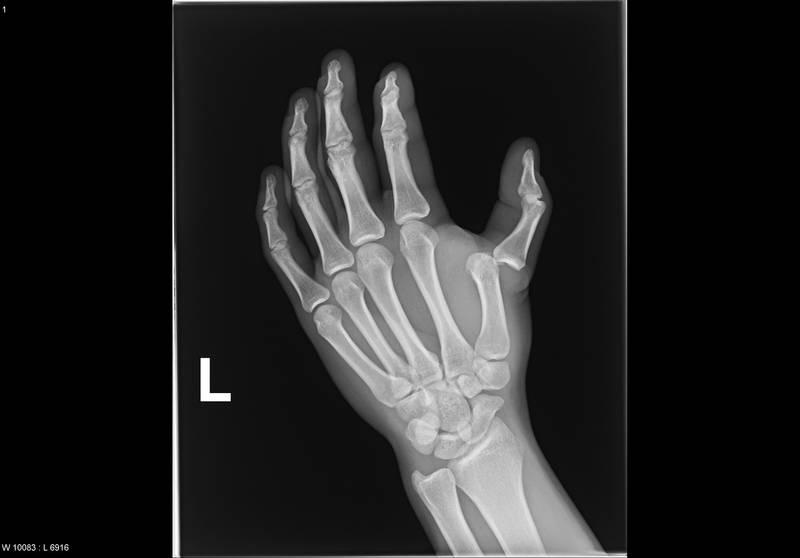Болит сустав большого пальца на руке - причины и лечение