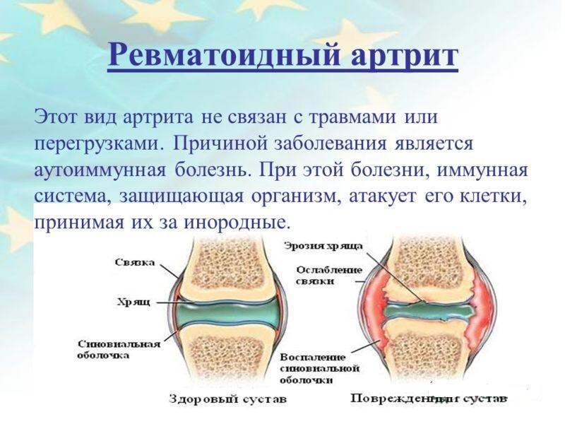 Изображение - Диабет и коленный сустав revmatoidnyj-artrit