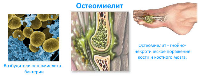 Гематогенный остеомиелит